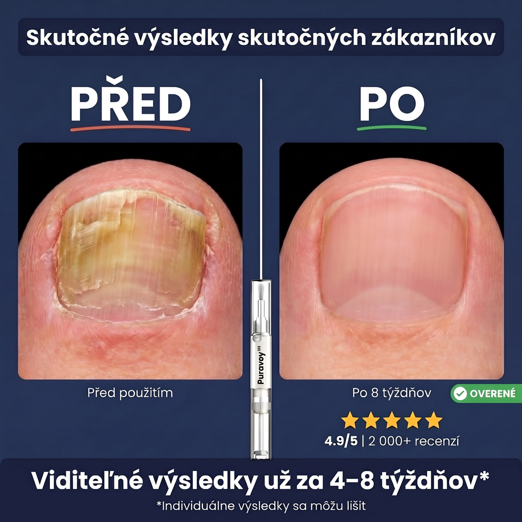 Puravey™ Antimykotické Pero — Zbavte sa plesne nechtov navždy (Bez bolesti. Bez zápachu. Bez skrývania.)
