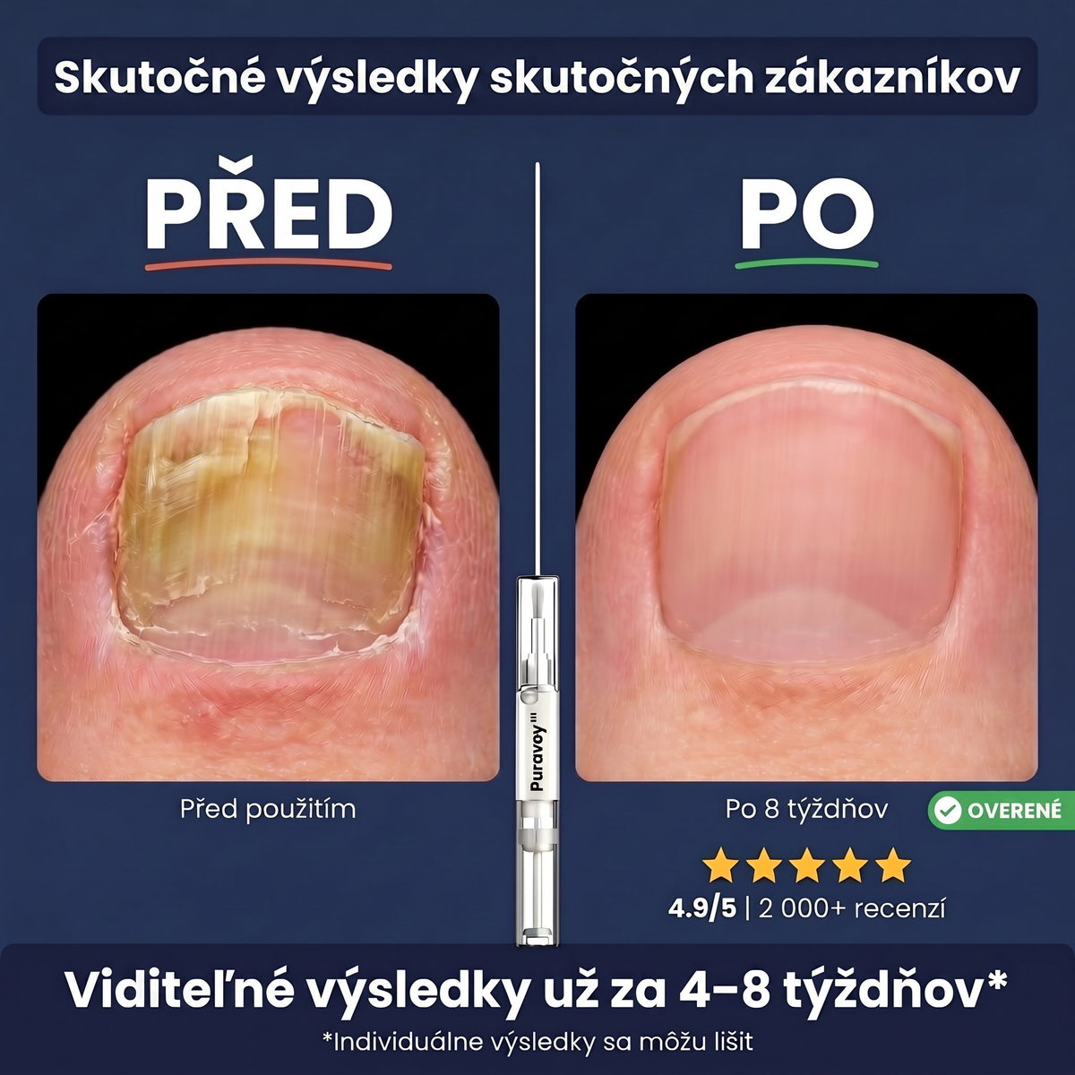 Puravey™ Antimykotické Pero — Zbavte sa plesne nechtov navždy (Bez bolesti. Bez zápachu. Bez skrývania.)
